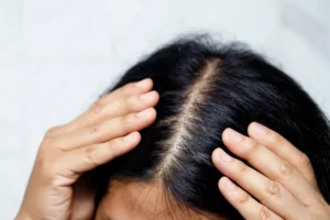 How to Get Rid of Oily Scalp at Home