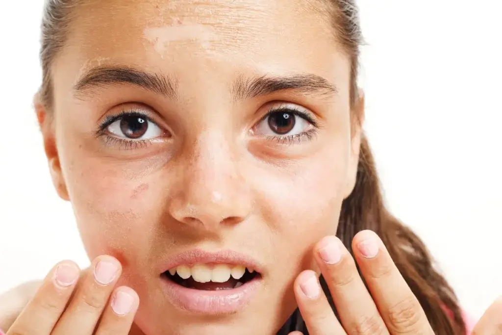 Multani Mitti Uses for Face & Skin Whitening - How to Use & Benefits 5 Soothes Sunburns and Inflammation