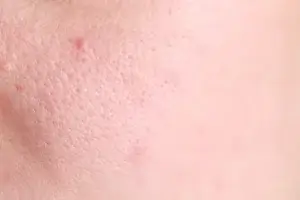 Steam to Open Pores