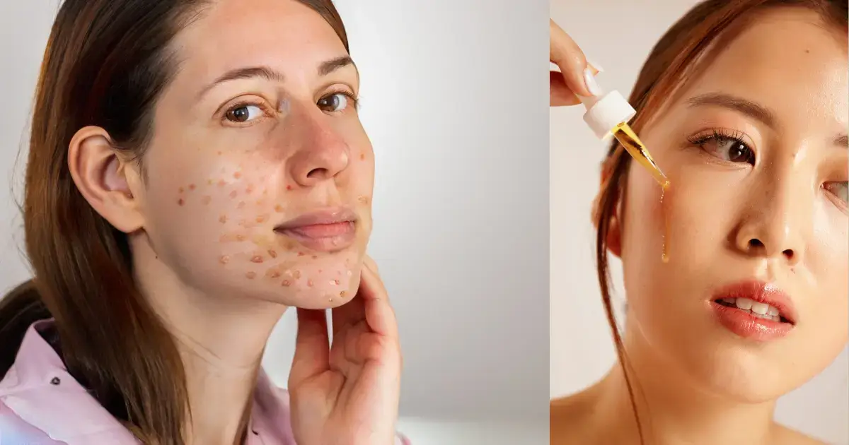 Niacinamide Uses for Skin, Face, & Acne - What Benefits & Side Effects